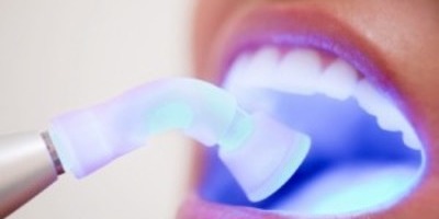 Ультразвукове відбілювання зубів: самий безболісний спосіб чищення ультразвуком