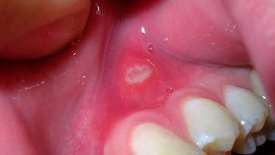 Стоматит заразний чи ні: чи передається інфекційний в роті у дорослих через поцілунок або як, заразний в інкубаційний період