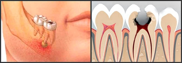 Травматичний пульпіт: що це, лікування хвороби зуба і його гострої форми, діагностика в клініці