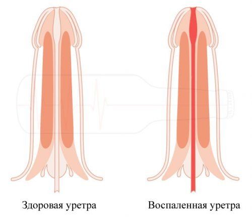 Особливості хронічного запалення сечовипускального каналу