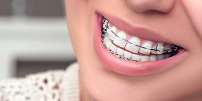 Брекети або капи: що краще для вирівнювання зубів, коли можна ставити замість елайнерів і чим вони відрізняються