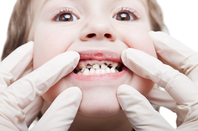 Пульпіт молочних зубів у дітей: що це таке, буває на тимчасових жувальних зубцях, може бути хронічний