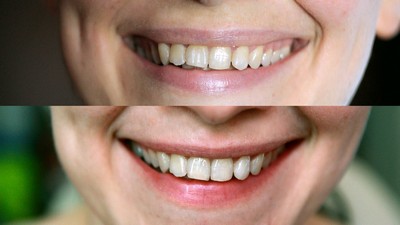 Зубна паста для відбілювання зубів: рейтинг кращих, тайська абразивна, ополіскувач Colgate, найефективніша, з вугіллям