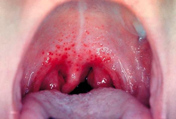 Лікування стоматиту у дітей: як лікувати дитину, фото, що робити при його появі у роті в дитячому віці, і як такого уникнути