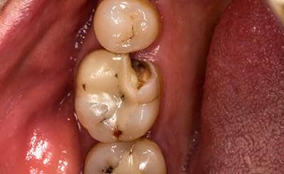 Глибокий карієс за МКБ 10, його симптоми, скарги і болю, дуже болить зуб при хронічному випадку, що це таке