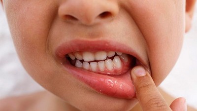 Періодонтит молочних зубів у дітей: лікування, тимчасова пломба, що це таке