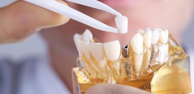 Після імплантації зубів рекомендації: післяопераційний період, реабілітація, що не можна робити, відновлення, чим полоскати рот