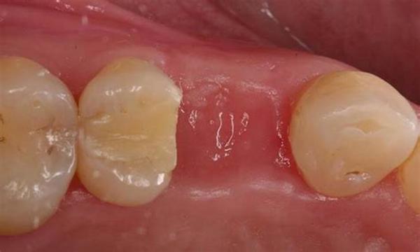 Боляче знімати шви після видалення зуба, біль при витягу кореня, це викликає дискомфорт?