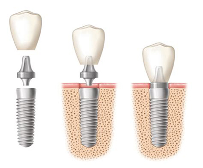 Імплантація зубів: скільки часу займає, чи довго триває протезування, як ставлять, терміни установки імпланта зуба