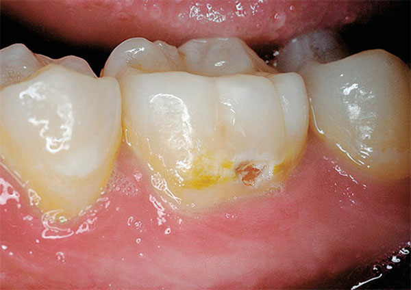 Поверхневий карієс зуба: код за МКХ 10, диференціальна діагностика, патогистология на поверхні, скарги при початковій формі