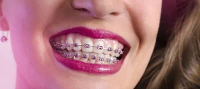 Скільки носять брекети, терміни носіння при лікуванні, як довго потрібно ходити дорослій людині, щоб вирівняти зуби, фото до і після