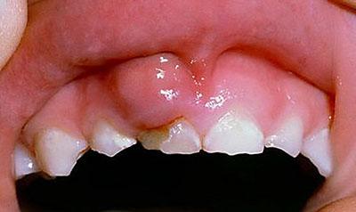 Карієс, пульпіт, депульпованого зуба, вторинний глибокий ускладнений періодонтит, МКБ 10, що таке гіперемія пульпи, лікування
