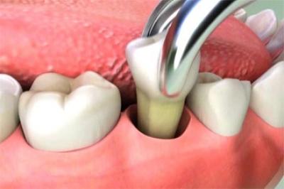 Як чистити зуби після видалення: коли можна доглядати за порожниною рота, чистка лунки, гігієна ясен, через скільки, другий день