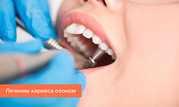 Методи лікування карієсу зубів: сучасні способи, озоном, ультразвуком, безконтактне, неінвазивне, повітряно абразивне