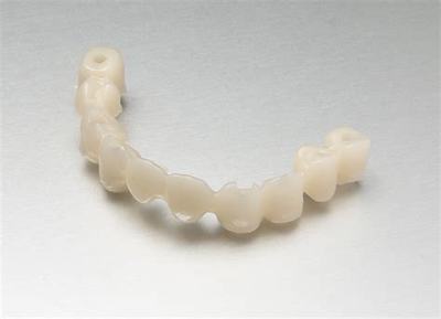 Імплантація передніх зубів: які імпланти поставити на передні верхні і нижні, особливості одномоментного протезування