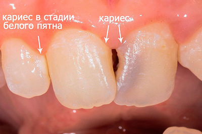 Початковий карієс: його початок і стадії, коли початківці маленькі симптоми розвиваються, ранній невеликий дискомфорт на зубах