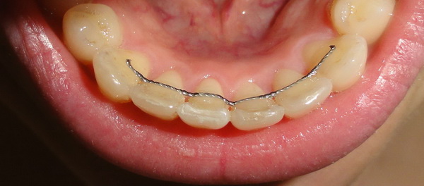 Ретейнери після брекетів: дріт на зуби, навіщо треба ставити, скільки потрібно носити, як відбувається установка і зняття, фото