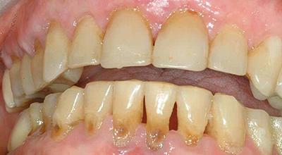 Пришеечный карієс: лікування придесневое, як лікують зуб в домашніх умовах, пломба на глибоку діру у десни, чи можна вилікувати