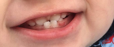 Виправлення прикусу у дітей: як виправляють неправильні зуби дитині в 2 роки, лікування, що робити, з якого віку виправити