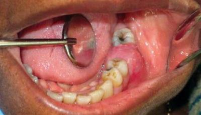 Знеболюючий укол при лікуванні зубів: що робити, якщо болить місце після видалення