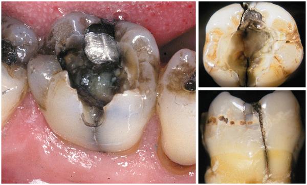 Пульпіт зуба мудрості: що це таке, симптоми хвороби, лікувати або видаляти?