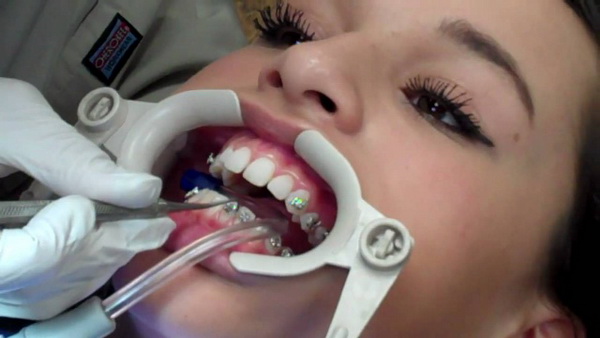 Брекети на верхню щелепу: чи можна поставити тільки на ці зуби і скільки вони болять після установки, чому ставлять спочатку одну