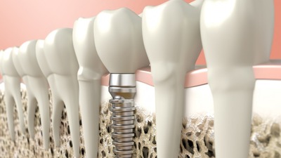 Технологія імплантації зубів: нові розробки в протезуванні без установки імплантів, всі етапи