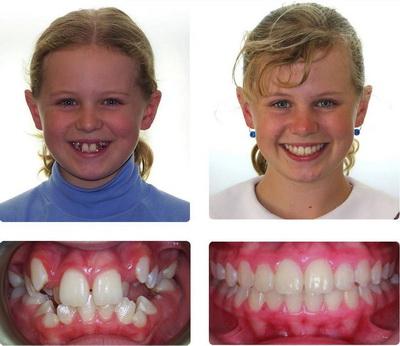 Дитячі брекети: чи потрібні вони дитині, які види краще ставити підлітку, який лікар може поставити скоби на зуби дітям, фото