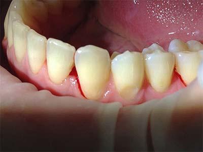 Карієс цементу зуба: клініка, діагностика, лікування, що таке в МКБ 10