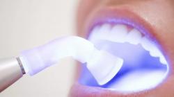 Відбілювання зубів системою Zoom – освітлення емалі зубів фотоотбеливанием