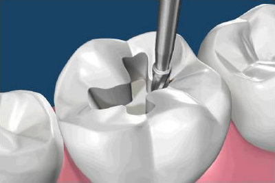 Карієс збоку зуба: бічний і його лікування, як лікують поразку на зубах біля десни