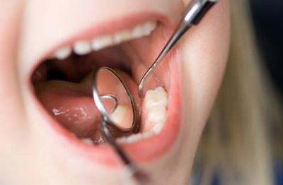 Карієс кореня зуба: що це таке, основні симптоми та код кореневого захворювання за МКБ 10, як його лікують