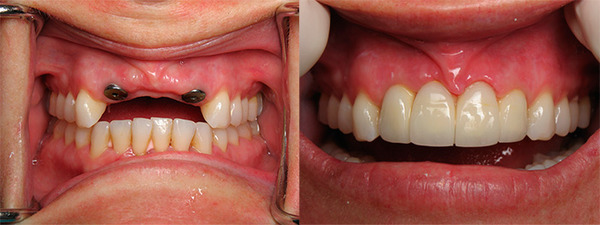 Нарощування кісткової тканини при імплантації зубів, як відбувається пластику ясен при зубному операції, як ставлять імплант на кістку