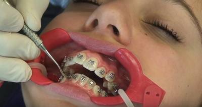 Сепарація зубів при носінні брекетів, потрібно чи видалення зуба мудрості перед установкою, навіщо четвірки, вісімки, фото до і після