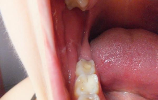 Болить горло після видалення зуба мудрості: чому біль при ковтанні, і що робити, якщо видалили капюшон з десни у роті