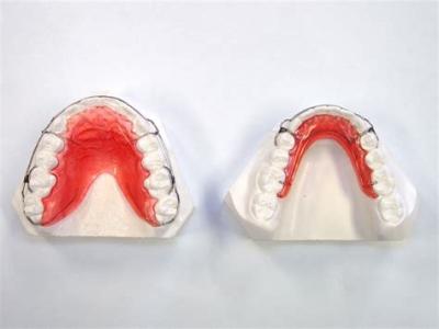 Чим відрізняються брекети від скоб: у чому різниця і які ортодонтичні системи краще