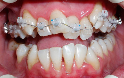 Прозорі брекети: як називаються непомітні скоби на зуби, фото