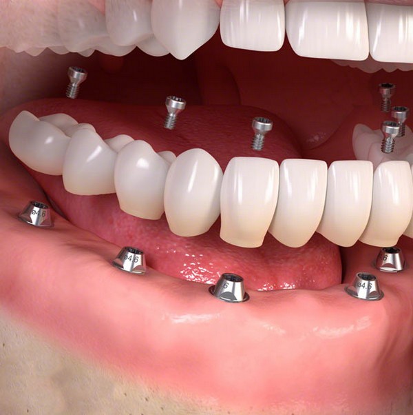 Повна імплантація зубів: заміна на імпланти всієї щелепи, відновлює відразу весь зубний ряд