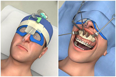 Виправлення прикусу хірургічним шляхом: операція на нижню щелепу для зміни форми у дорослих, фото до і після, реабілітація