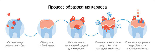 Карієс на передніх зубах, з внутрішньої сторони верхніх різців у дорослих