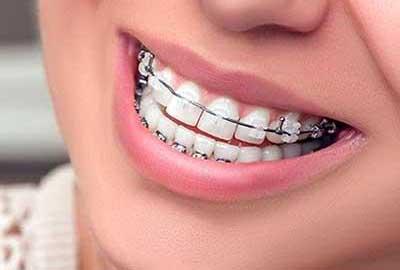 Брекети до і після лікування кривих зубів, результати посмішки на фото по місяцях, відчуття при носінні, вирівнюванні і установці
