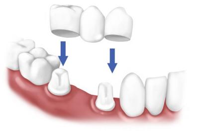 Як лікують карієс між зубами: лікування міжзубного і контактного поразки у жувальних