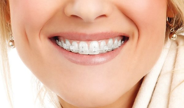 До скількох років можна ставити брекети для вирівнювання зубів дитині, коли краще встановлювати дітям, в якому віці дорослим