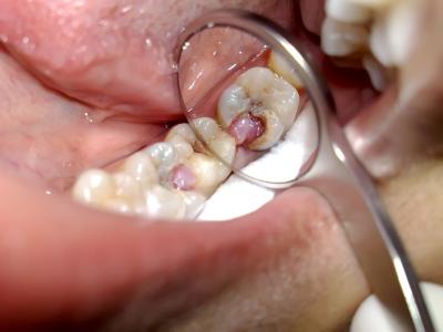 Чим зняти зубний біль в домашніх умовах дорослому, швидко: як лікувати або позбавитися від неї