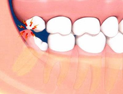 Карієс зуба мудрості, потрібно лікувати або видаляти в разі глибокого ураження