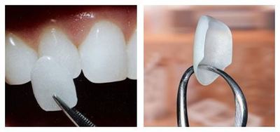 Зуби після брекетів: що ставлять і носять в життя, потрібні для закріплення художня реставрація, шинування і відбілювання