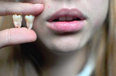 Пульсуючий зубний біль після видалення зуба мудрості