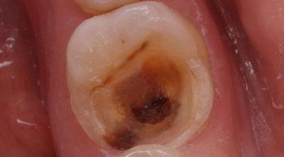 Дірка в зубі болить: що робити в домашніх умовах, як зменшити дуже сильний зубний біль від зруйнованої пломби або нерва