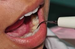 Видалення зубного каменю. Як видаляють зубний камінь, чи боляче це?