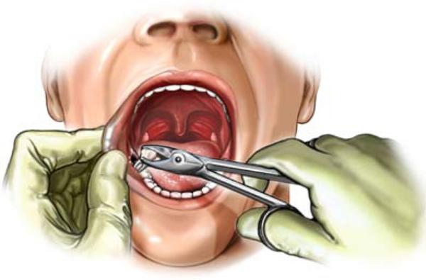 Болить щелепа після видалення зуба мудрості: скільки буде тривати біль, якщо моляр тільки що видалили